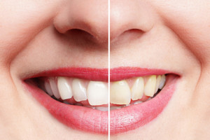 Frau vor und nach dem Zähne bleichen